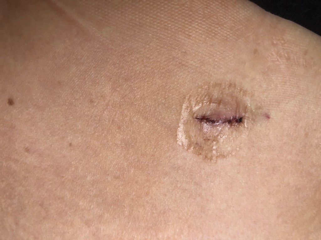 5 Days Post&nbsp;op